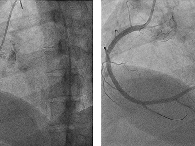 Oclusión total de CD y reperfusión con flujo TIMI III luego de angioplastía exitosa