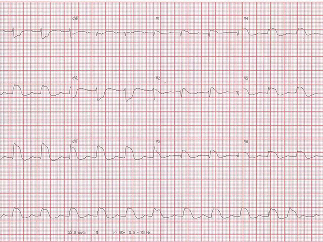 Oclusión total de la CD. ¿Fenocopía de Brugada asociada?