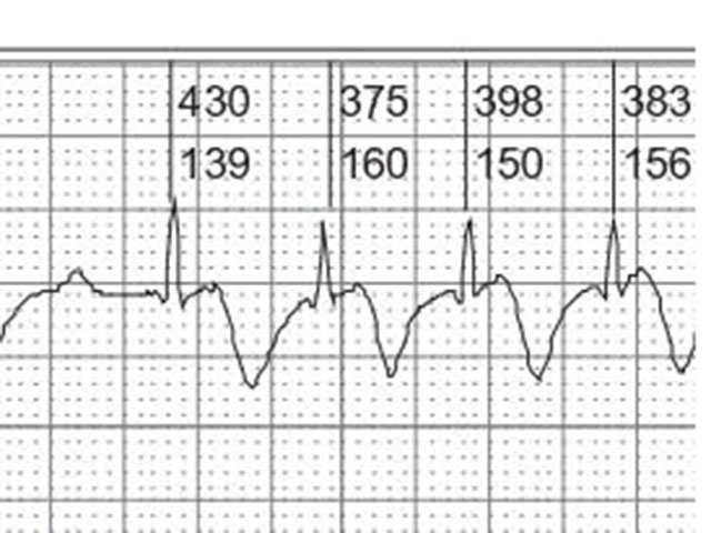 Paciente con marcapasos definitivo. ¿Cuál es la espiga, cuál el QRS y la onda T?