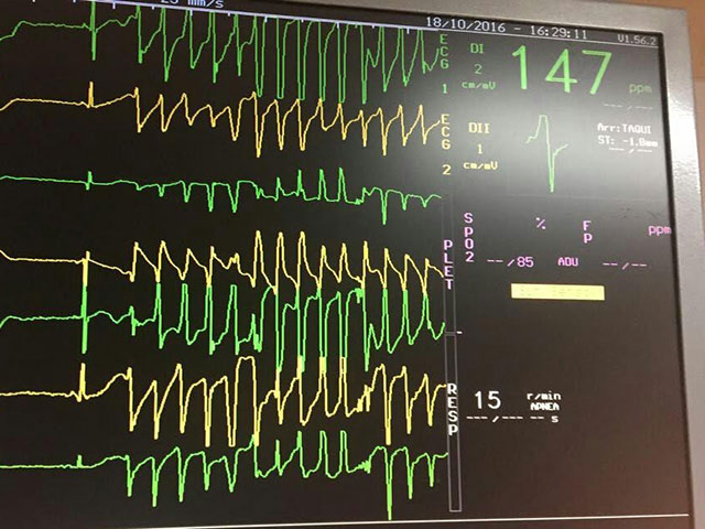 Paciente esquizofrénica que fue tratada con Zuclopentixol/Sertindol