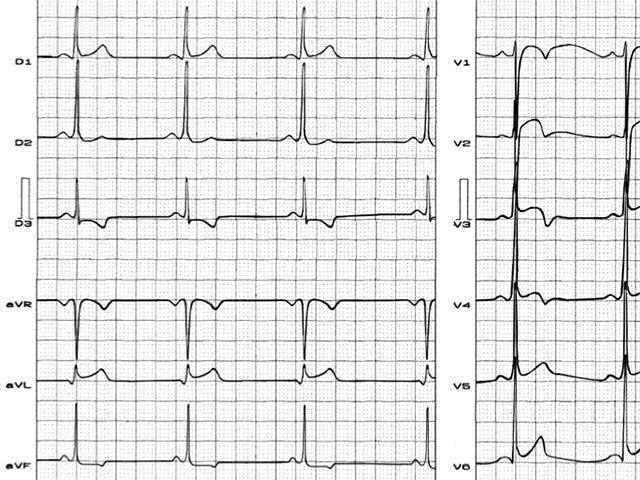 Pattern of pseudo subepicardial injury and ischemia in anterior wall in an athlete, professional player of basketball with normal heart