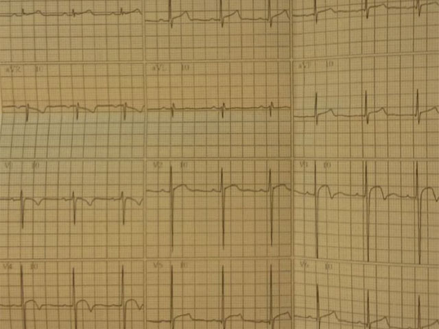 Pseudo epicardial injury pattern in anterior leads in thirteen years old child