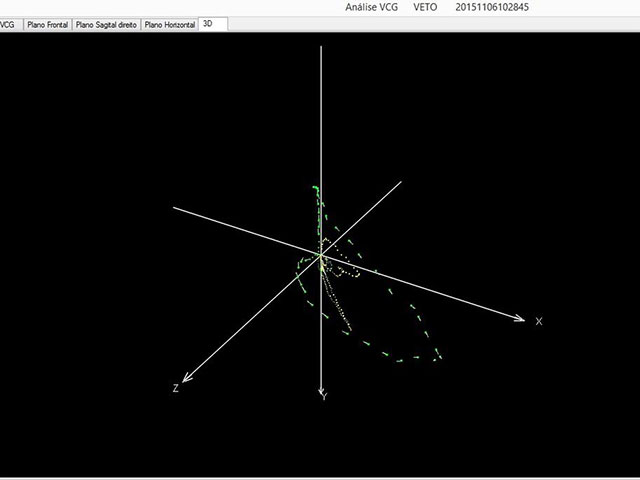 VCG en repolarización precoz