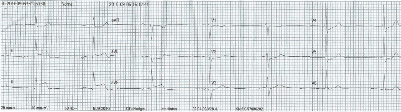 ACV isquémico con ECG que simula un SCACEST de cara inferior