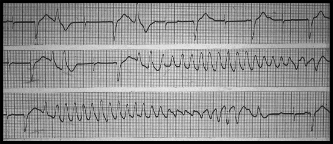 Agotamiento de generador de MP VVI