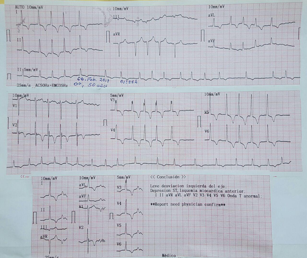 Masculino 50 años con MCH con atc de TV presenta episodio presincopal por FA rápida