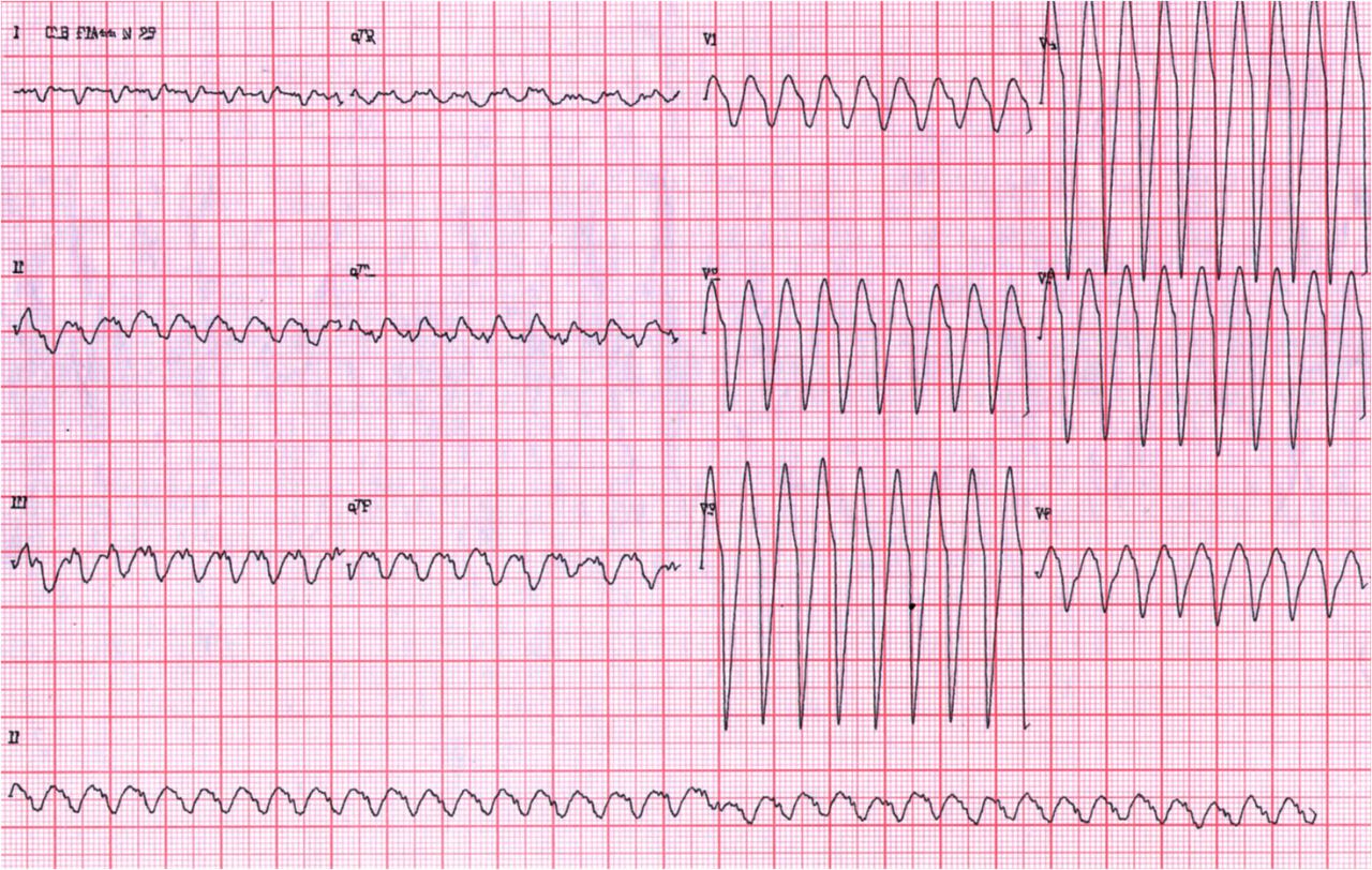 Arritmia desencadenada por propafenona