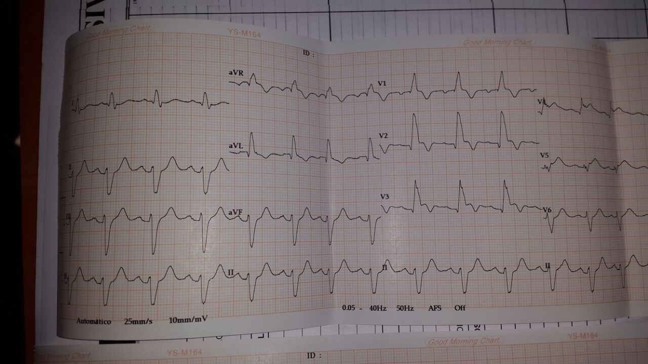 IAMCEST +BCRD + BDASI + Fuerzas anteriores prominentes (FAP)