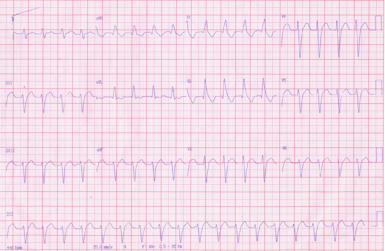 Taquicardia ventricular fascicular posterior verapamilo sensible