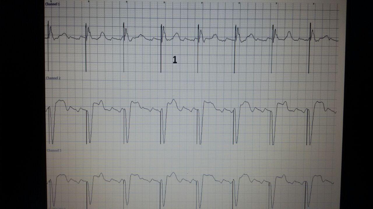 Aleteo auricular y marcapasos DDI