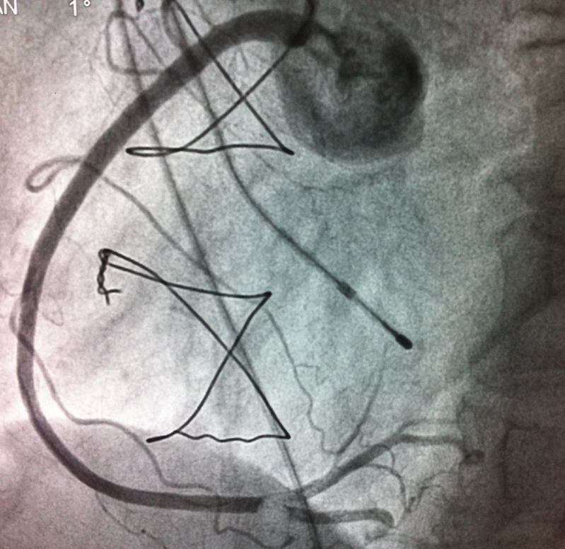 EMBOLO EN ARTERIA CORONARIA DERECHA DISTAL