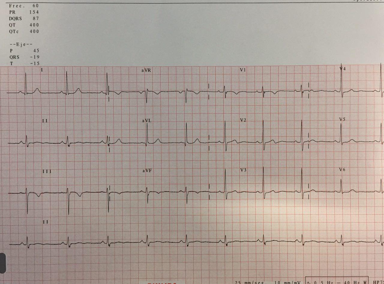 Paciente masculino de 67 años con atc. de angor típico II de reciente comienzo. IAMSEST