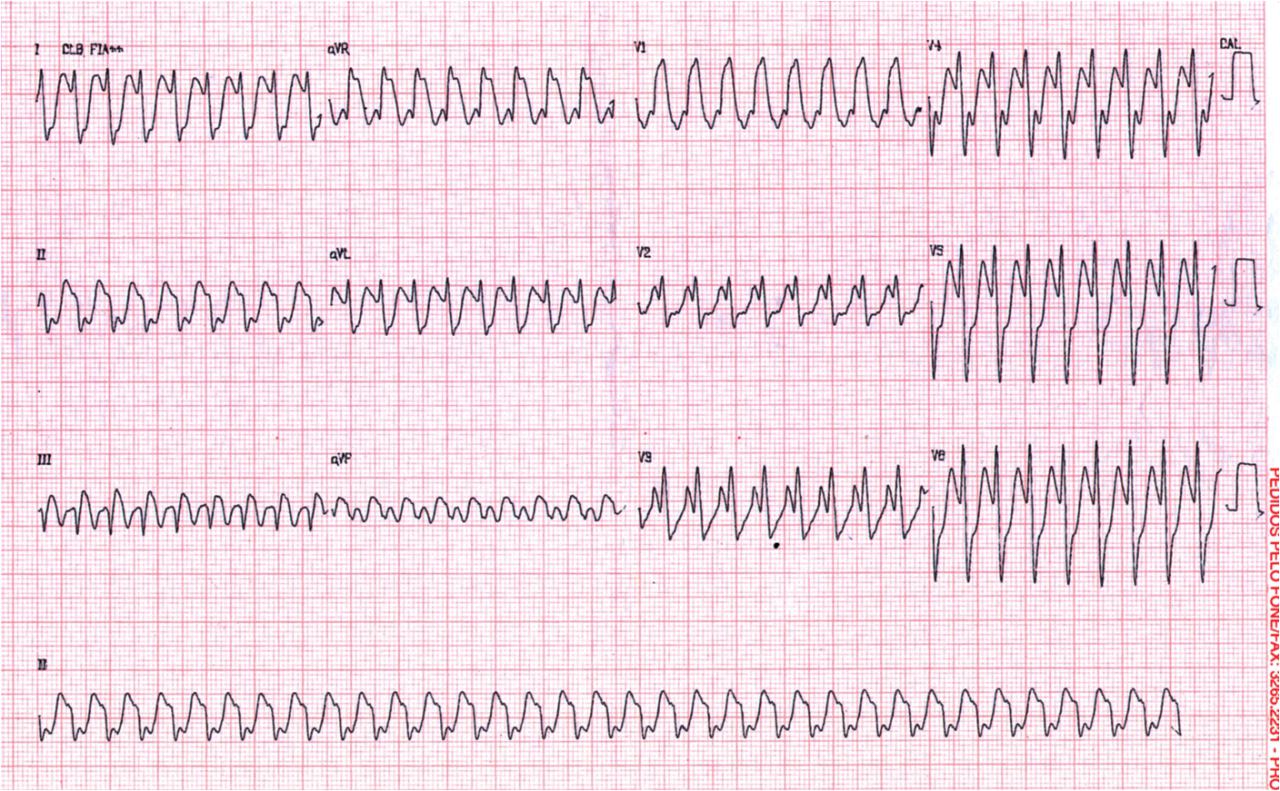 Secuencia ECG de paciente portador de aleteo auricular