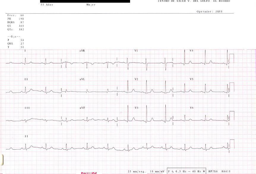 Rotación antihoraria del eje en paciente con secuela TBC + Insuf aórtica. Dextroversión adquirida
