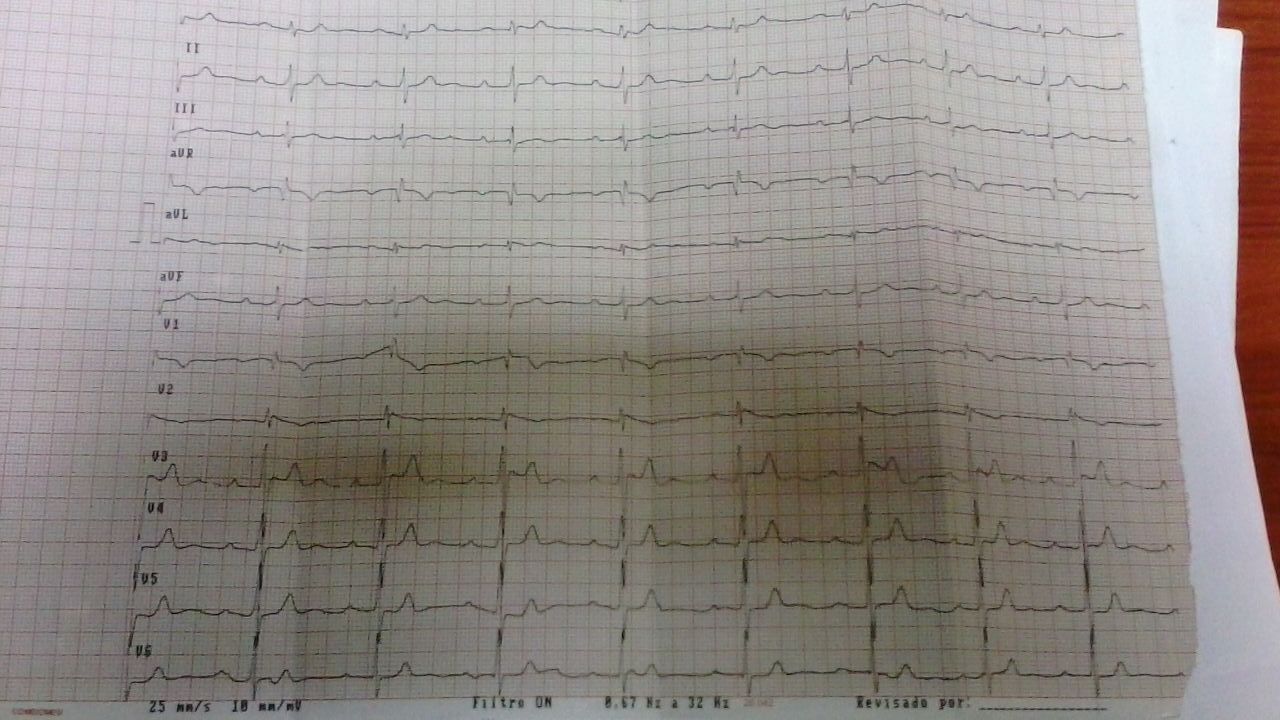 Síndrome de Holt Oram