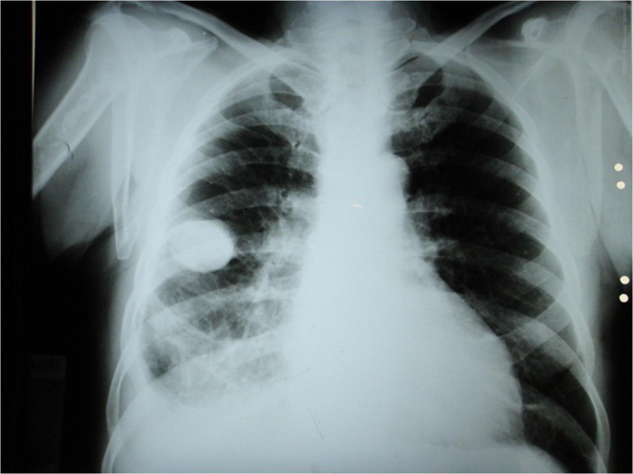 Tumor evanescente o fantasma por insuficiencia cardíaca que mejora y desaparece con diuréticos