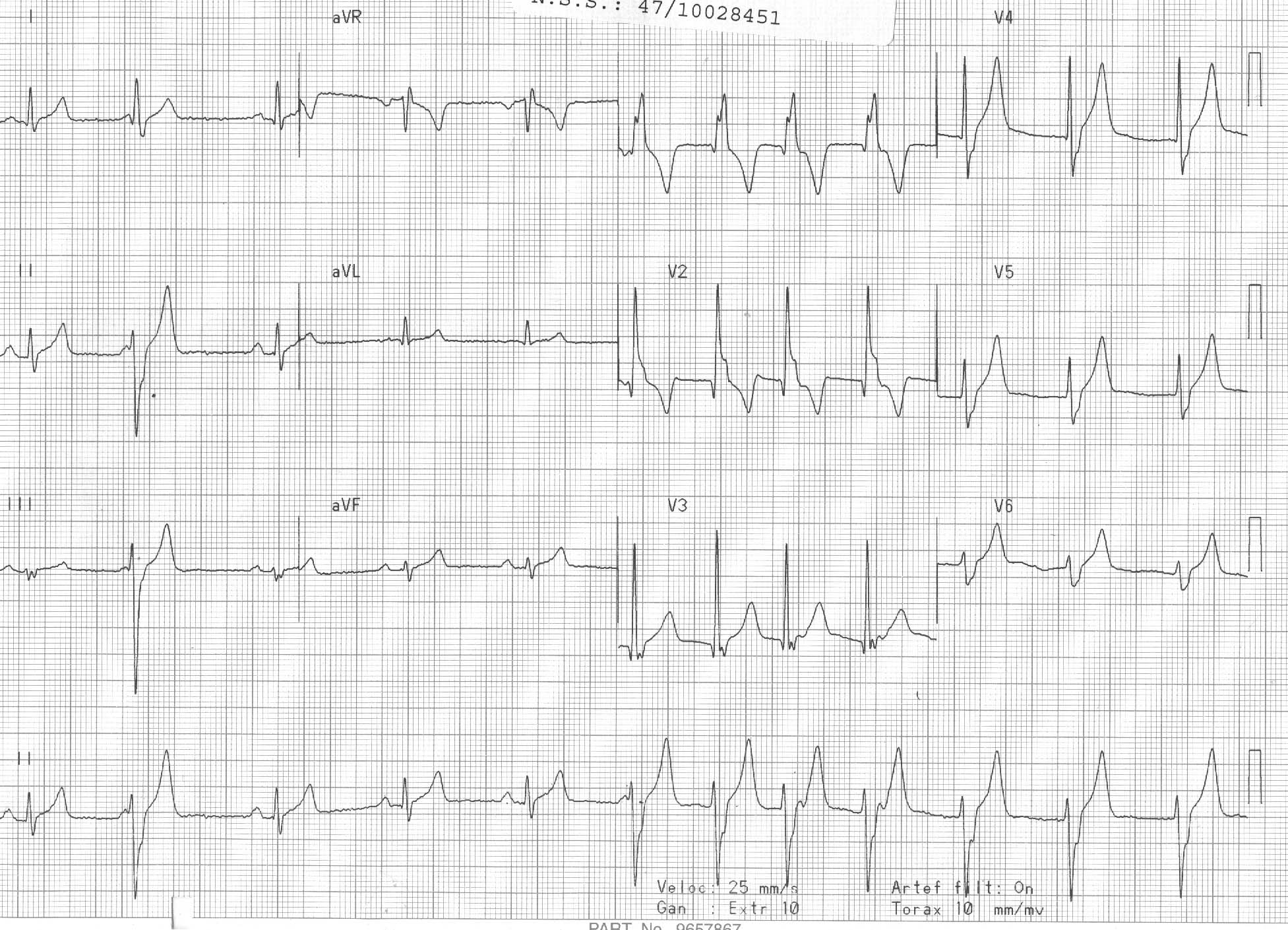 Ritmo idioventricular irregular