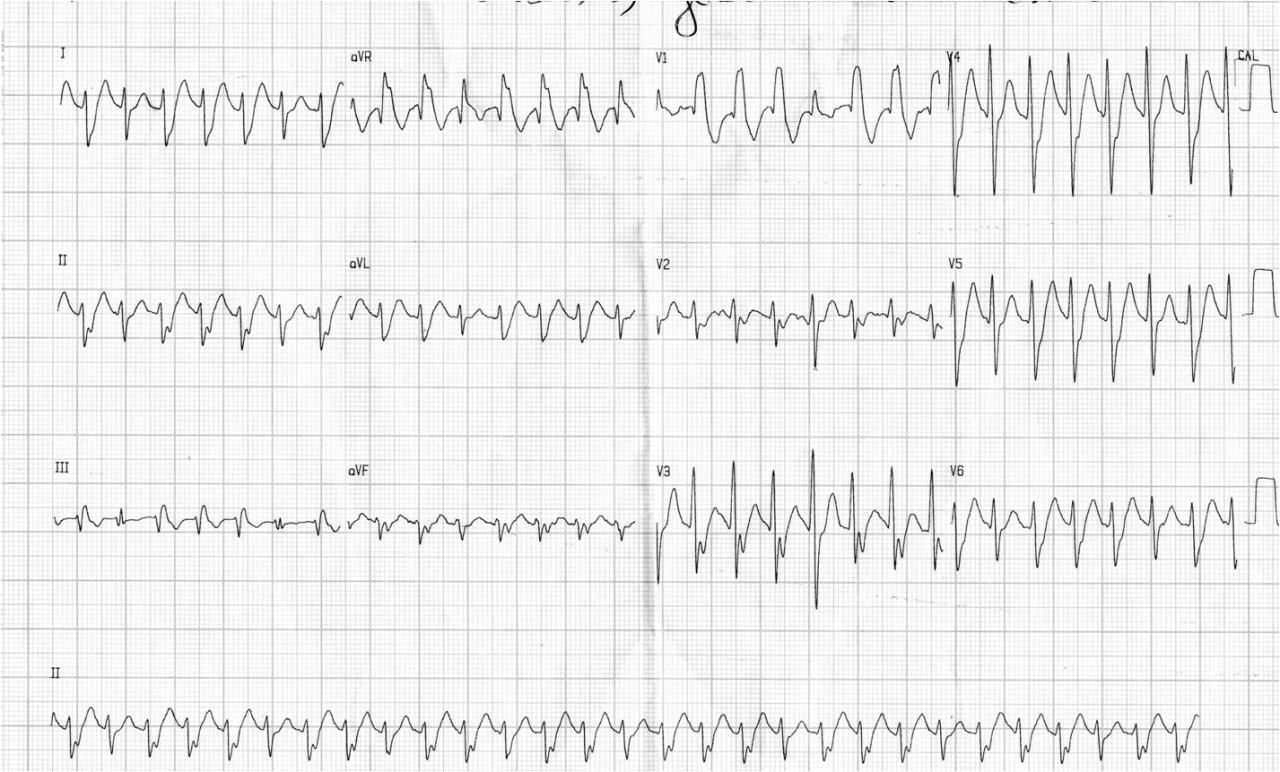 Taquicardia fascicular posterior sensible a la adenosina