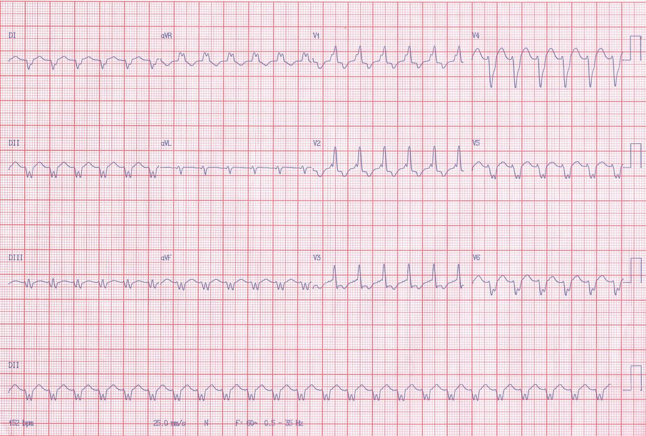 ¡Parece una TV, pero no es!! (ver respuesta a la adenosina)