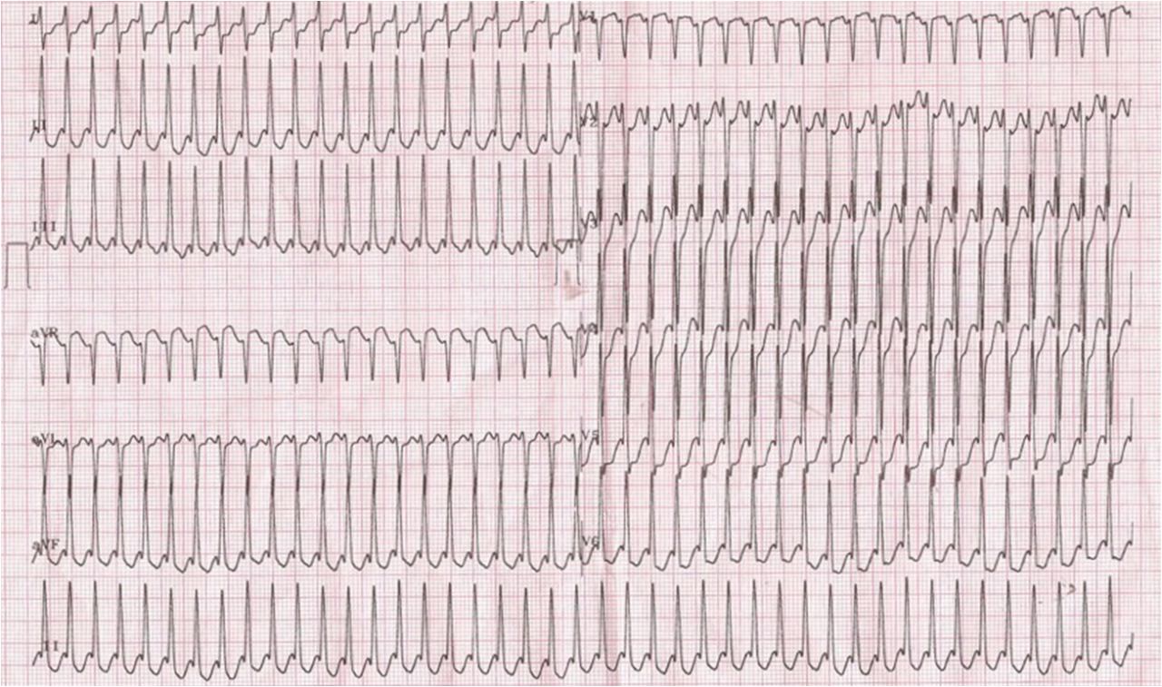Taquicardia por reentrada ortodrómica. Via lateral izquierda.