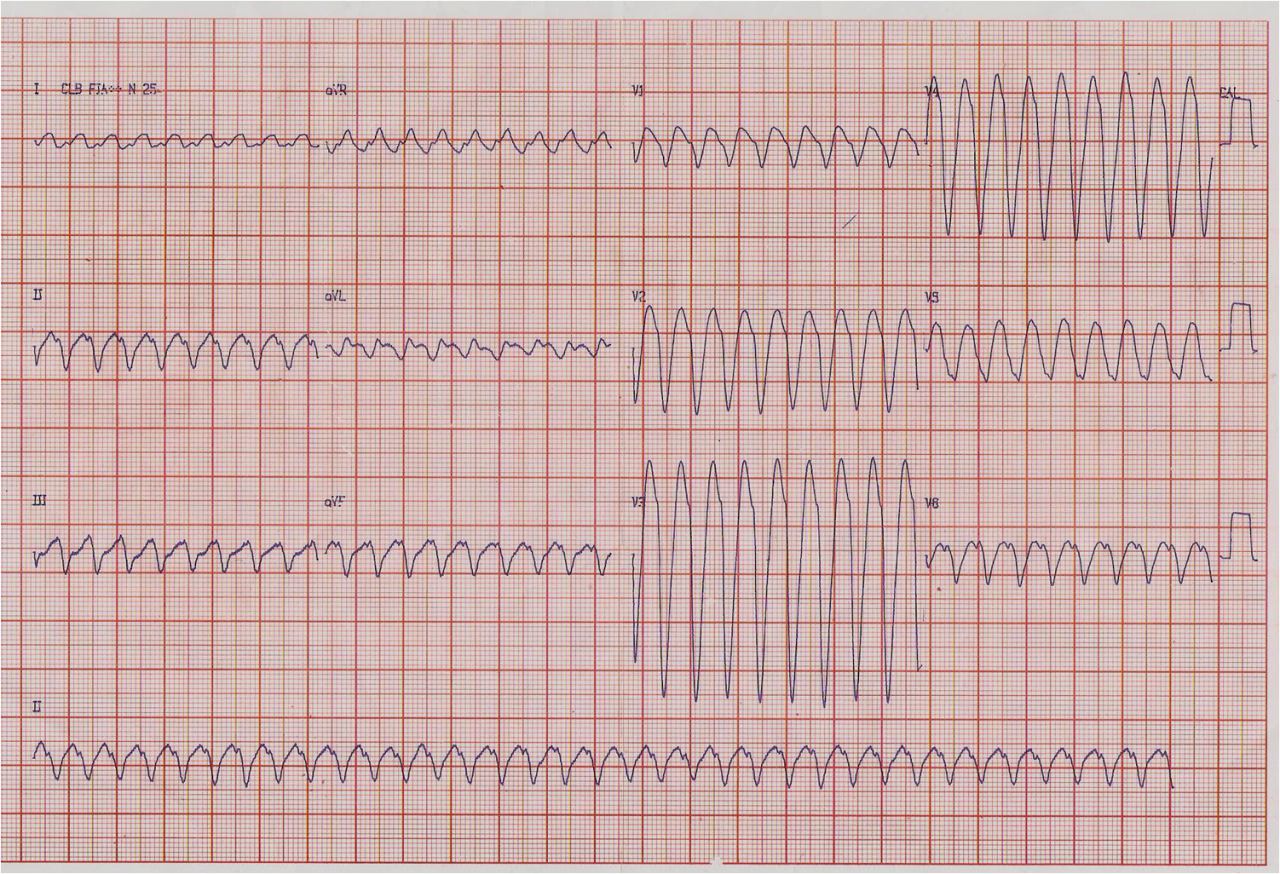 Taquicardia ventricular por reentrada rama a rama