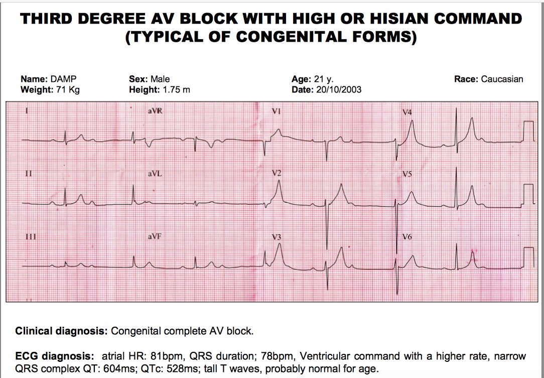 Congenital complete AV block