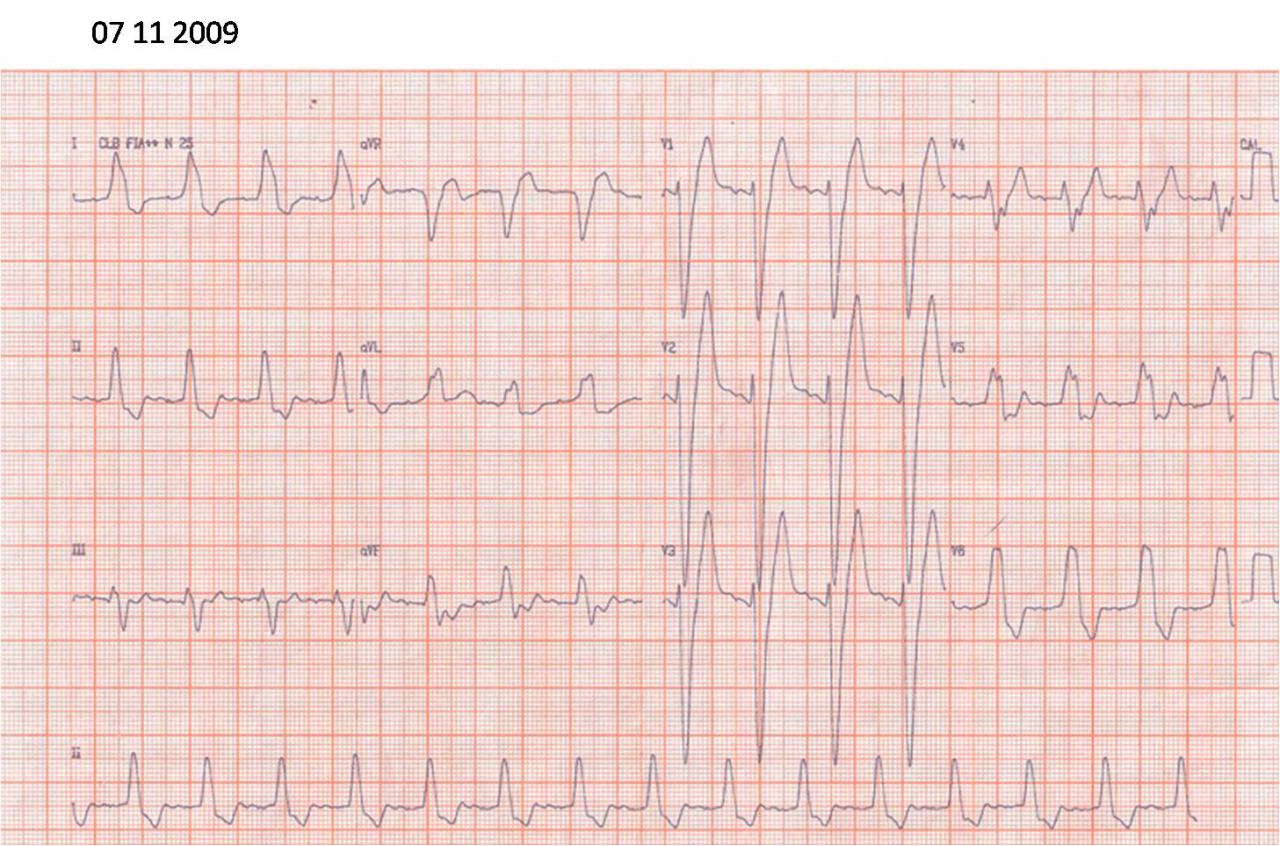 Secuencia ECG de paciente de 71 años. Trazados de 2009, 2010 y 2017 cuando presentó episodios sincopales