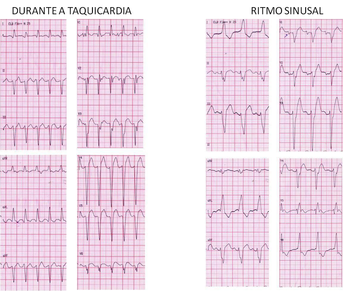 TV de QRS más angosto que el presentado en ritmo sinusal. Hipótesis: reentrada rama a rama