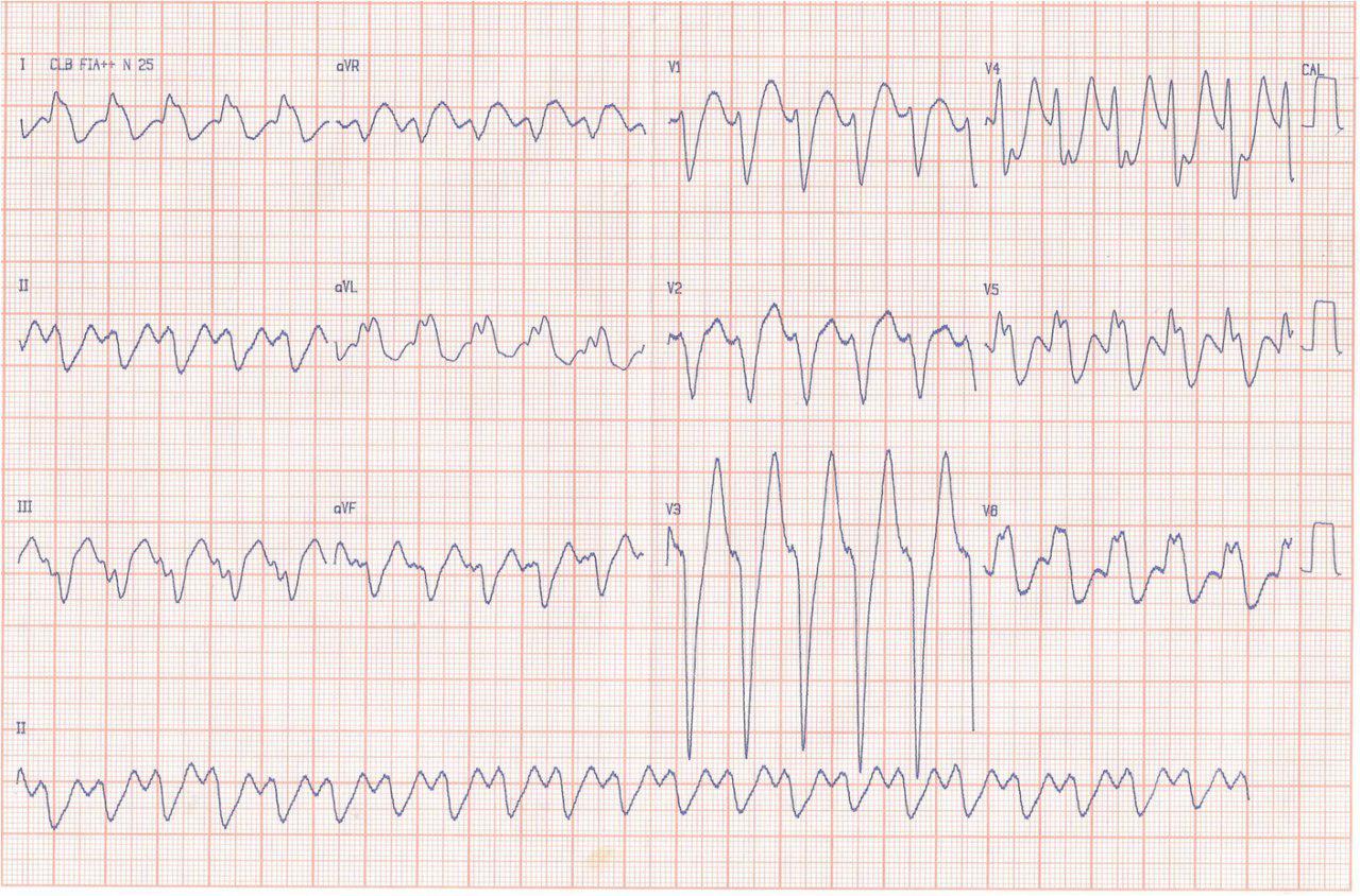 Varón, 22 años Palpitaciones taquicardicas y sincope. DAVD.