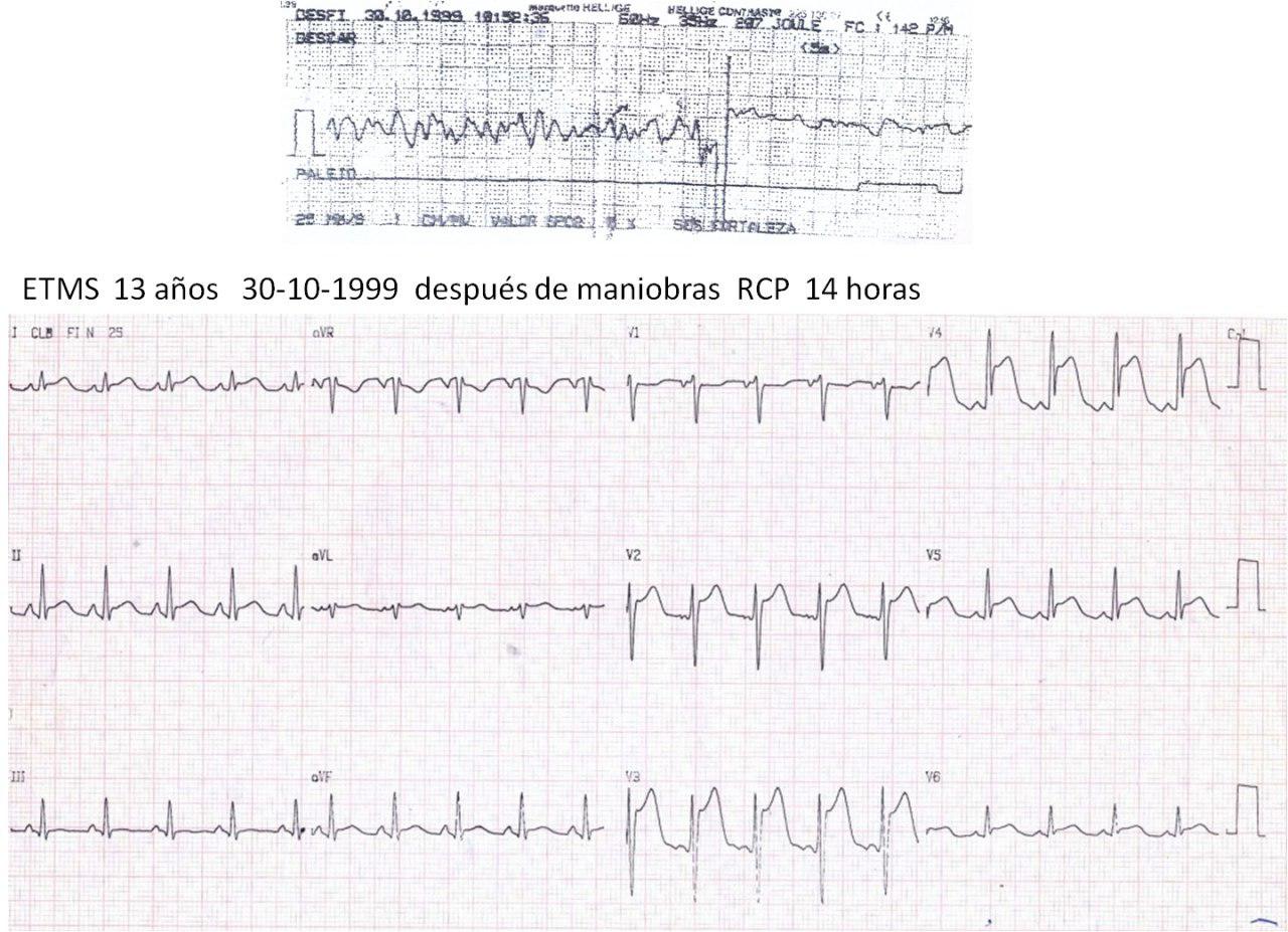 Repolarización precoz maligna en joven