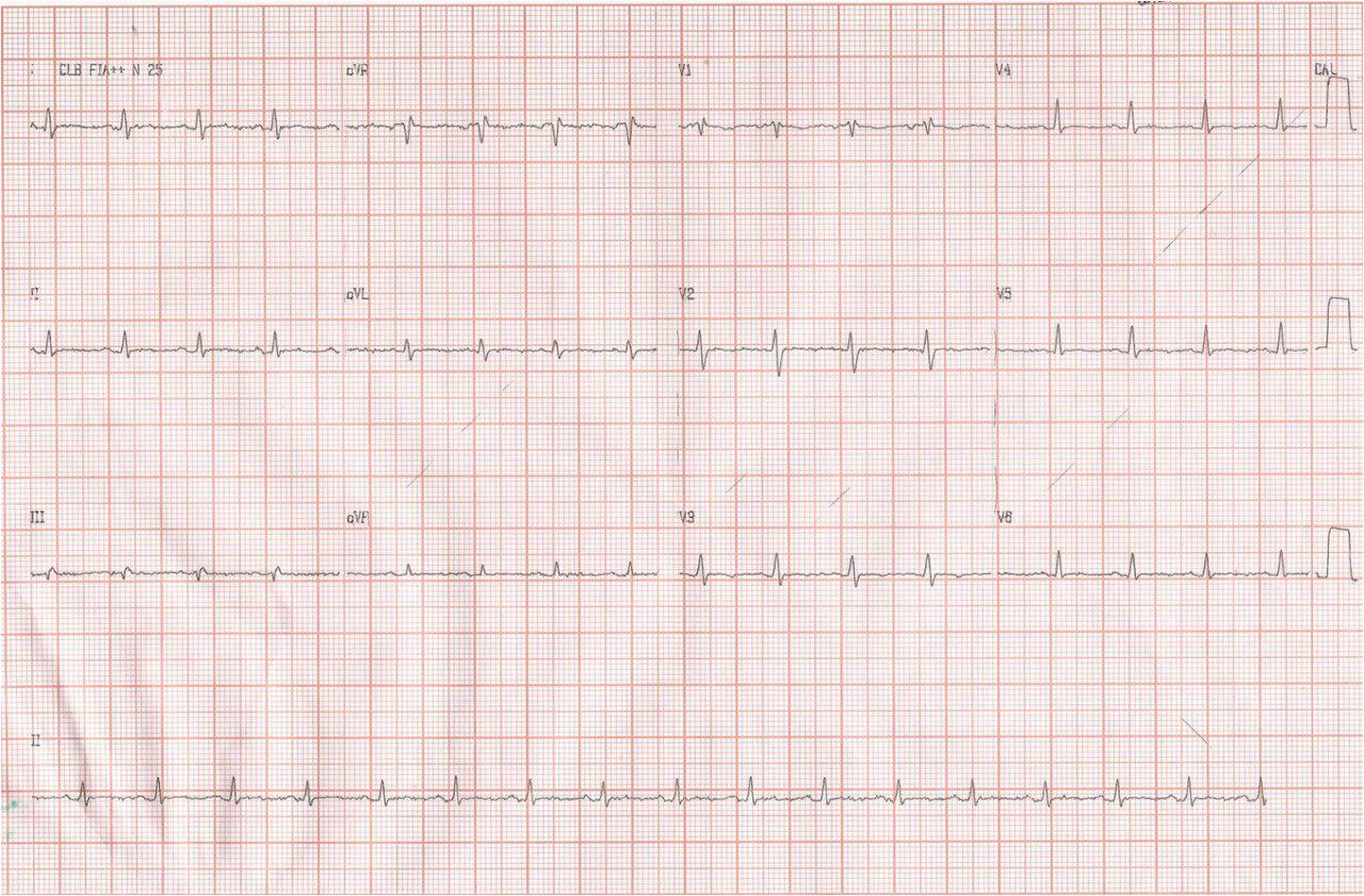 Varón de 20 años con historia de disnea progresiva de 2 meses de evolución. Pericarditis TBC.