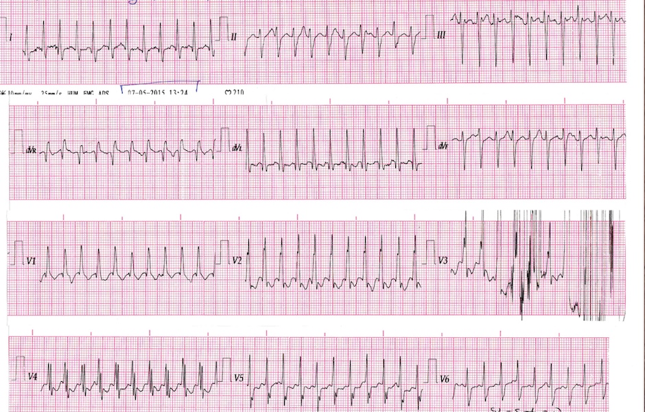 Taquicardia incesante