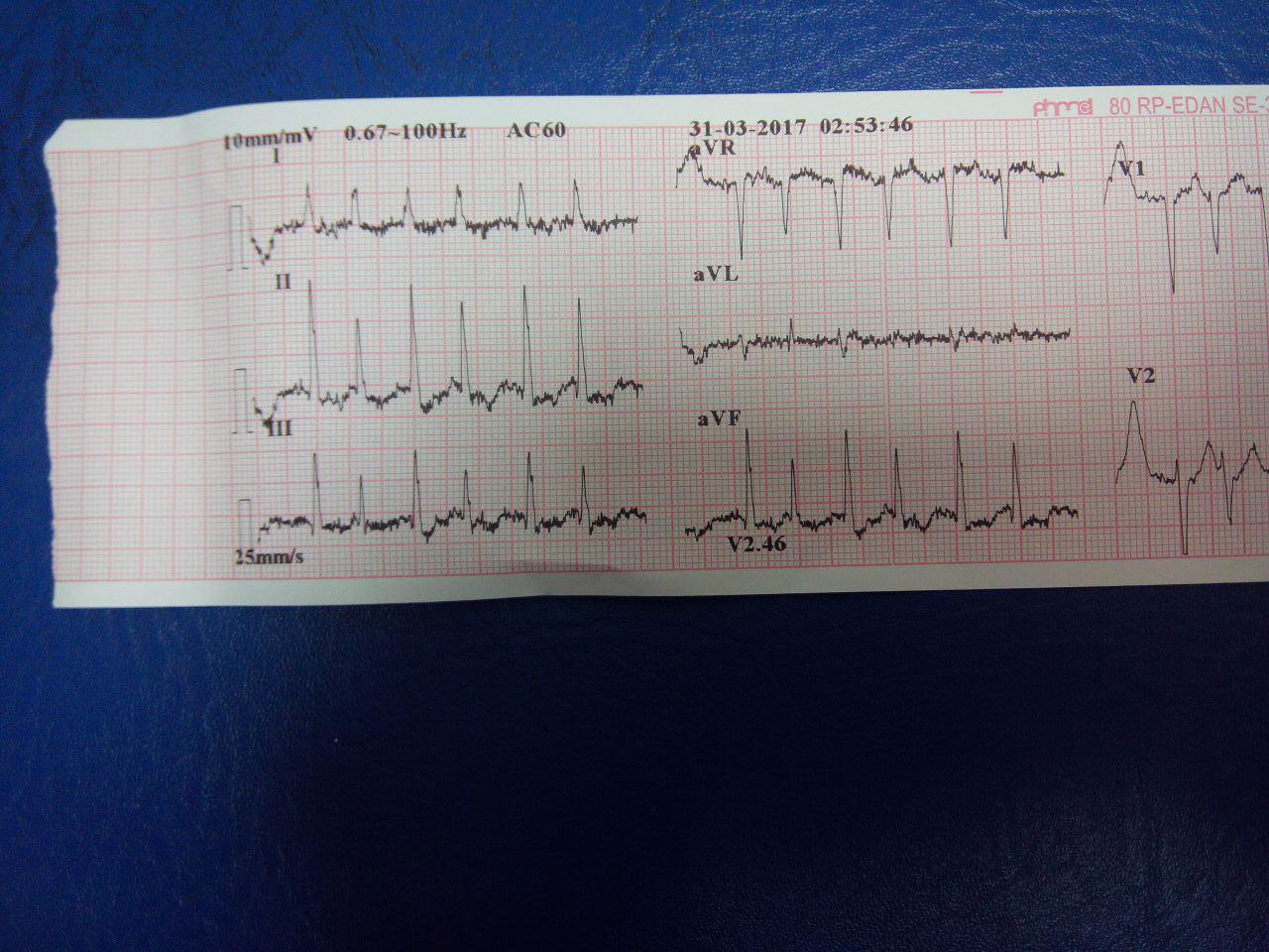 Paciente de 79 años hallado por los bomberos con ACV y hemiplejía izquierda
