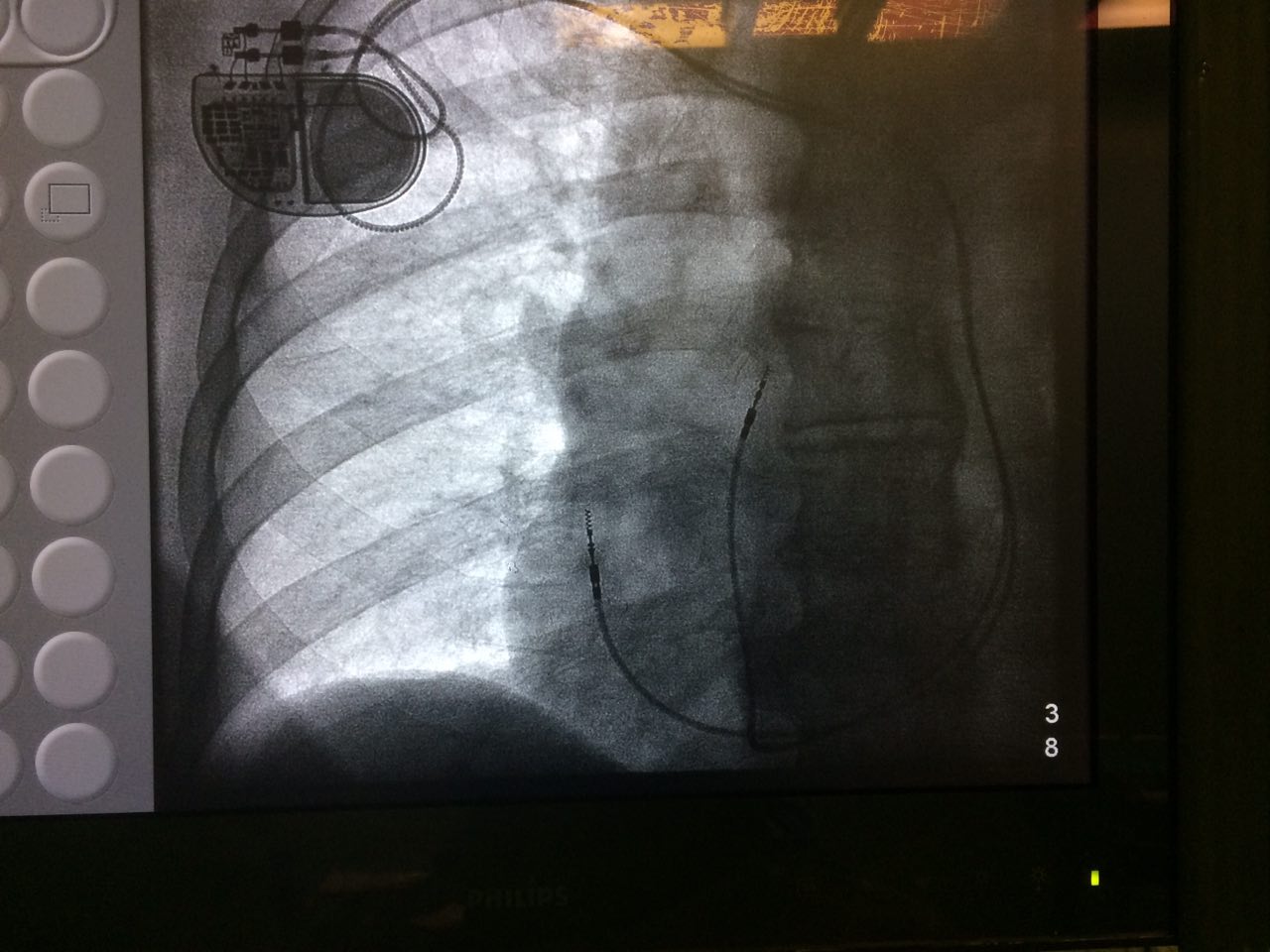 Catéter MP auricular alojado en vena cava superior izquierda