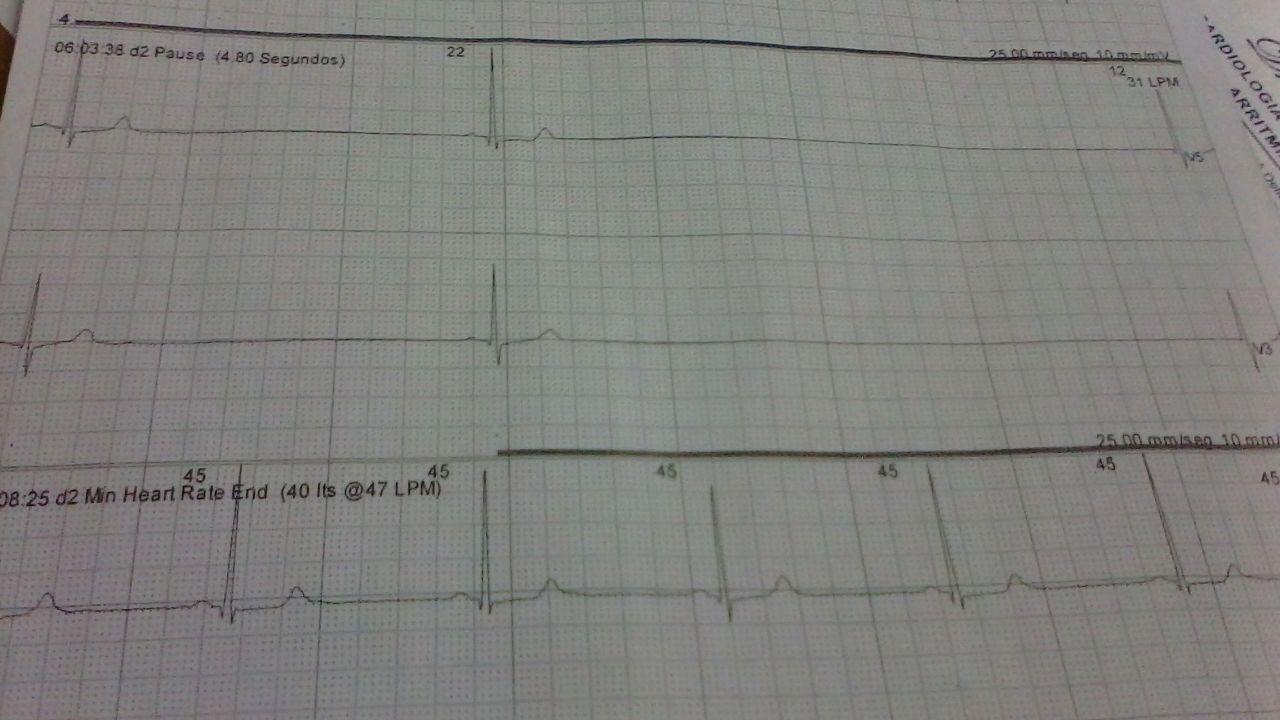 Paciente de 60 años con paros sinusales de hasta 5 segundos y RIVA