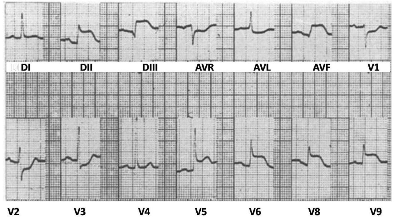 Paro cardíaco por actividad eléctrica sin pulso en mujer con SCA ínferolateral