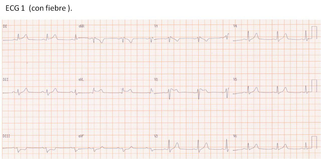 Síndrome de Brugada desencadenado por fiebre