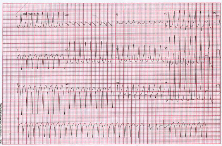 Masculino 72 años con angor y diaforesis. Trazados post cardioversión. ¿TV o FA preexitada?