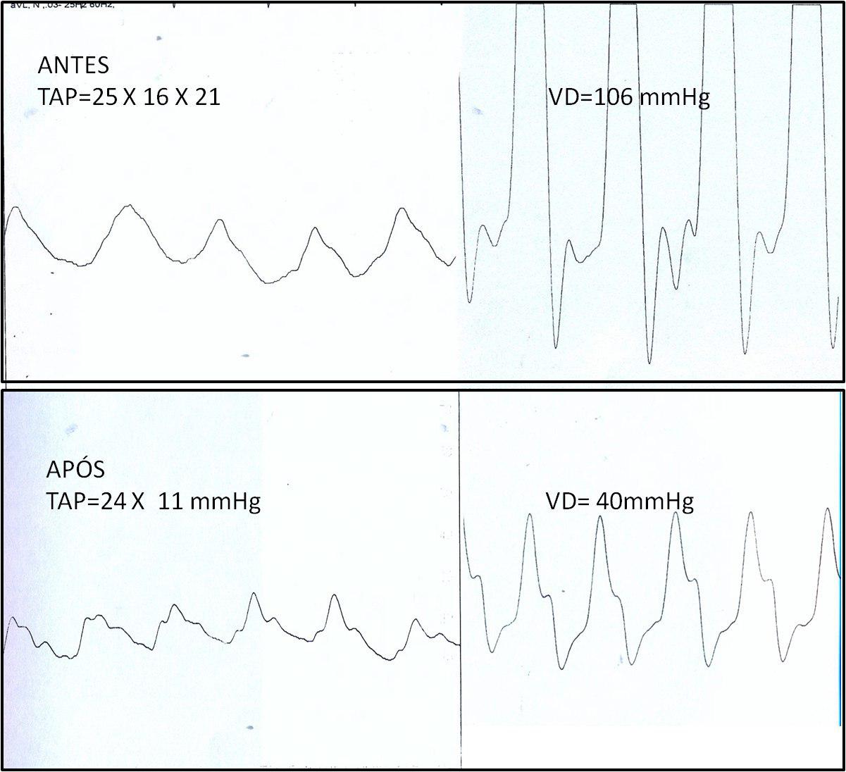 Valvuloplastia pulmonar exitosa