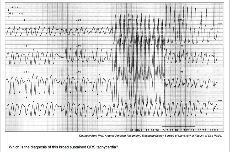Broad sustained QRS tachycardia