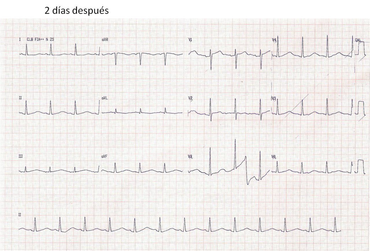 Prolongación del QT por azitromicina en mujer de 75 años y normalización al suspender la droga