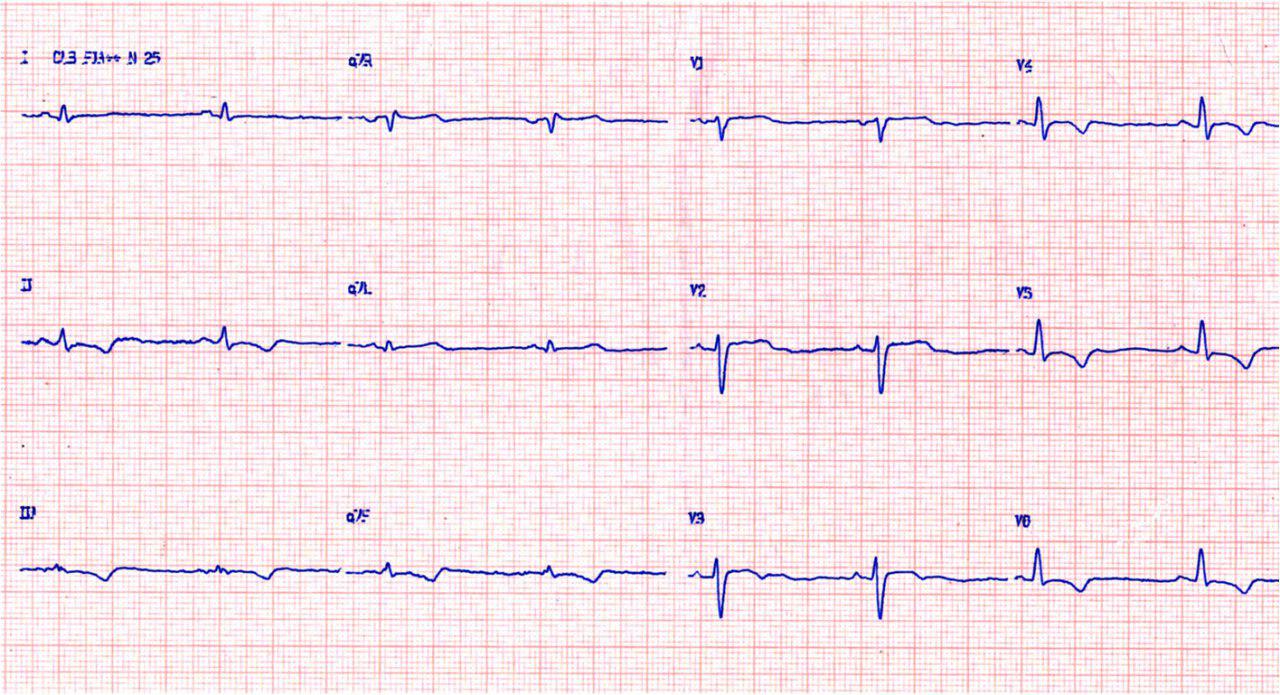 Chagasic patient with Fey 43% has implanted an ICD