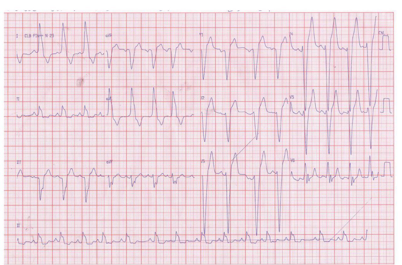 Suboclusión de ramo marginal de la arteria Cx en paciente en diálisis