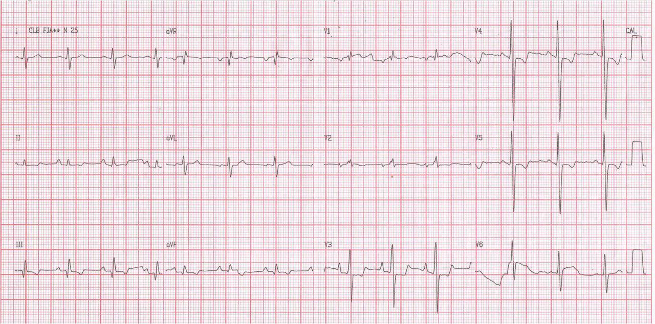 Paciente de 30 años con Hipertensión pulmonar primaria