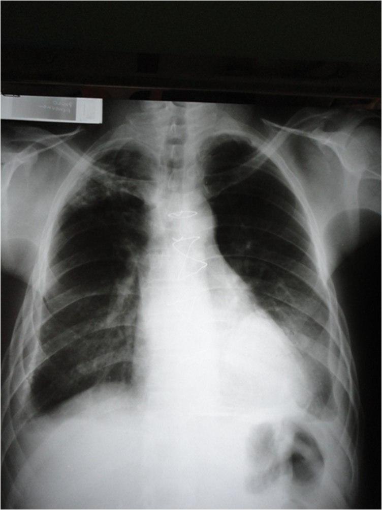 Pericarditis constrictiva en paciente alcoholista con CRM previa