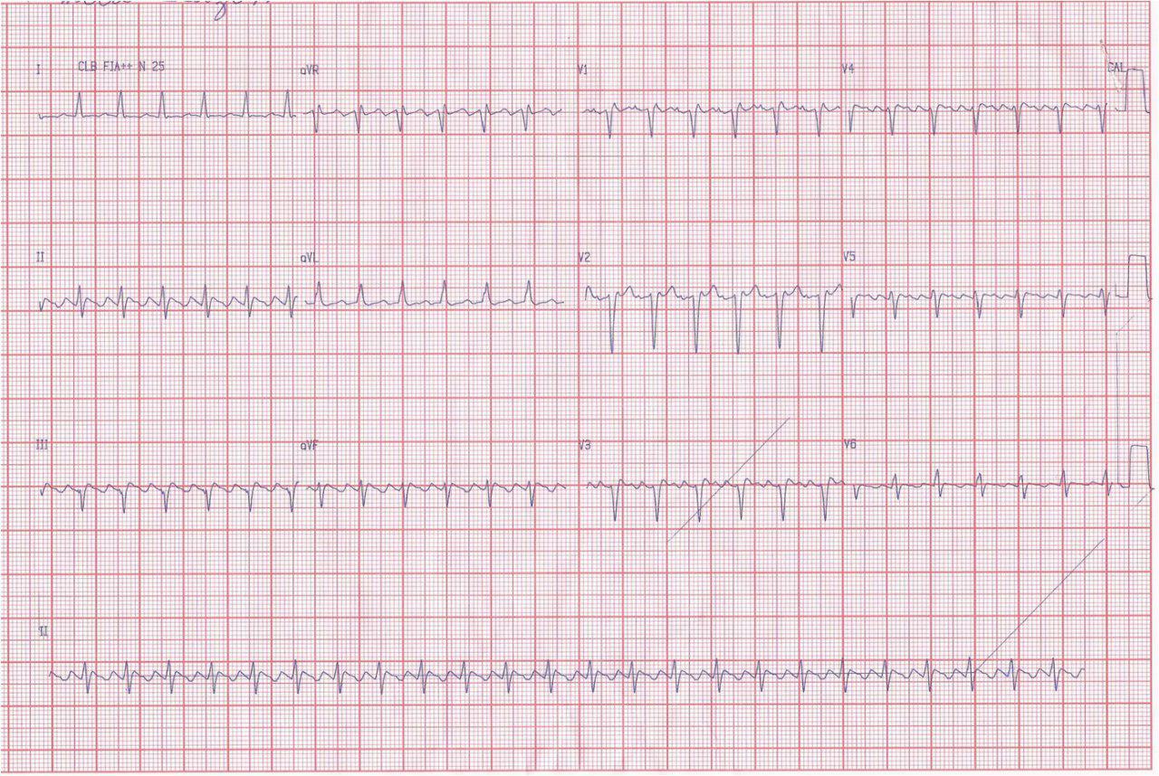 Aleteo auricular en joven hipertiroidea de 25 años