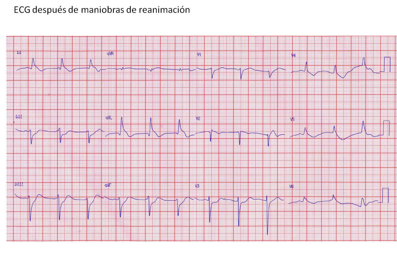 Masculino de 22 años que debuta con FV con nacimiento anómalo de arteria coronaria