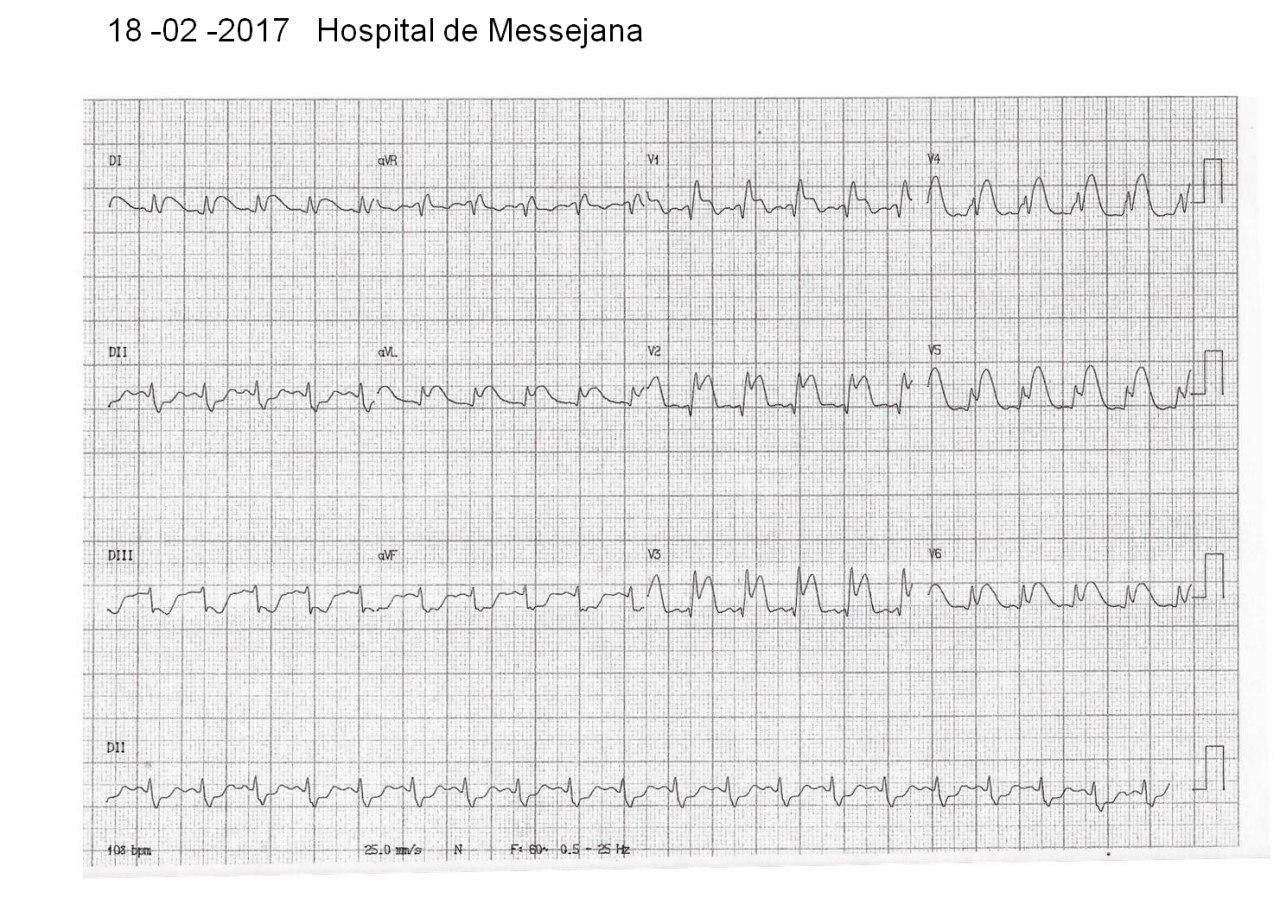 Paciente masculino de 38 años con Foramen oval permeable. TEP masivo e IAM extenso