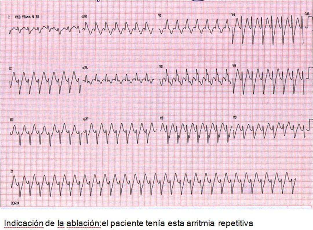 TV ablacionada y posterior memoria cardíaca en el ECG