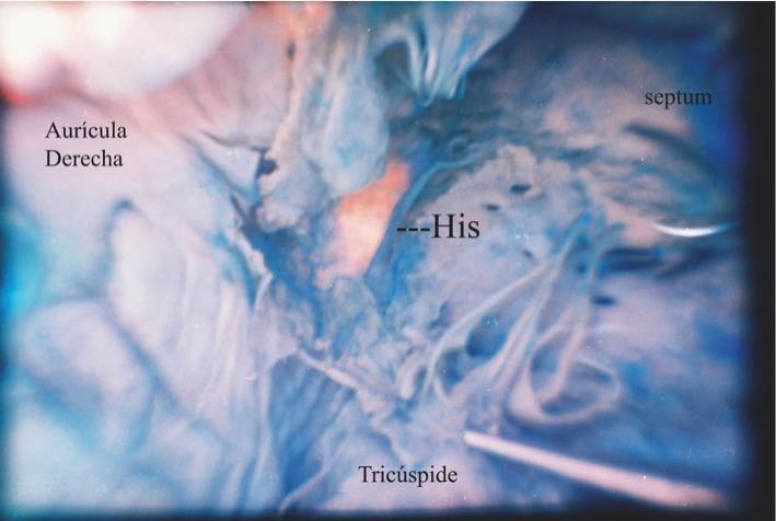 Haz de His disecado, entre el septum membranoso arriba y el muscular debajo